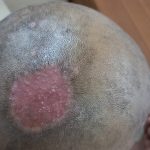 Fungal Infection Scalp after