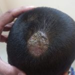 Fungal Infection Scalp Before