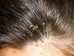 hairfall treatment chennai